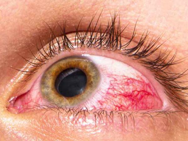 آیا فشار چشم خطرناک است؟